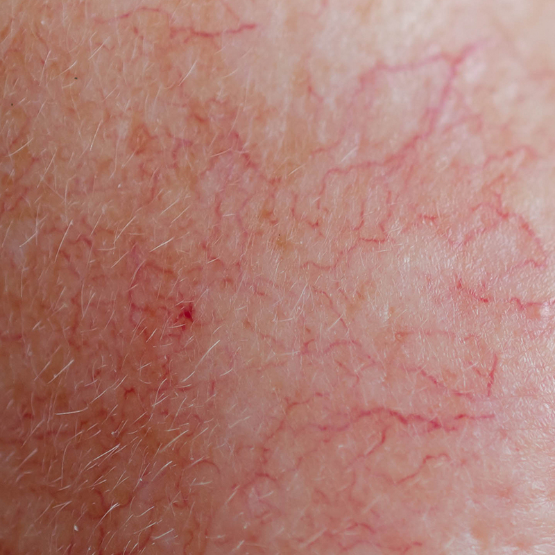 Close-up of facial skin showing persistent redness